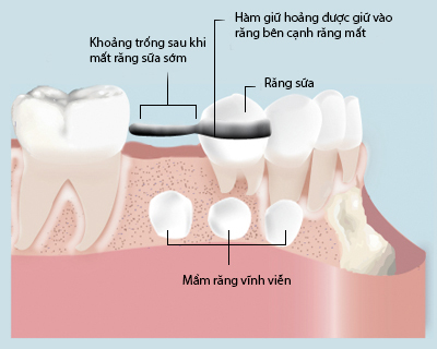 giữ khoảng trống cho răng mọc